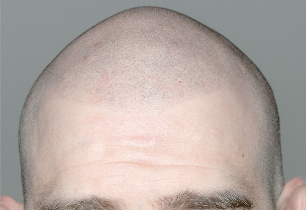 Micropigmentacion capilar despues