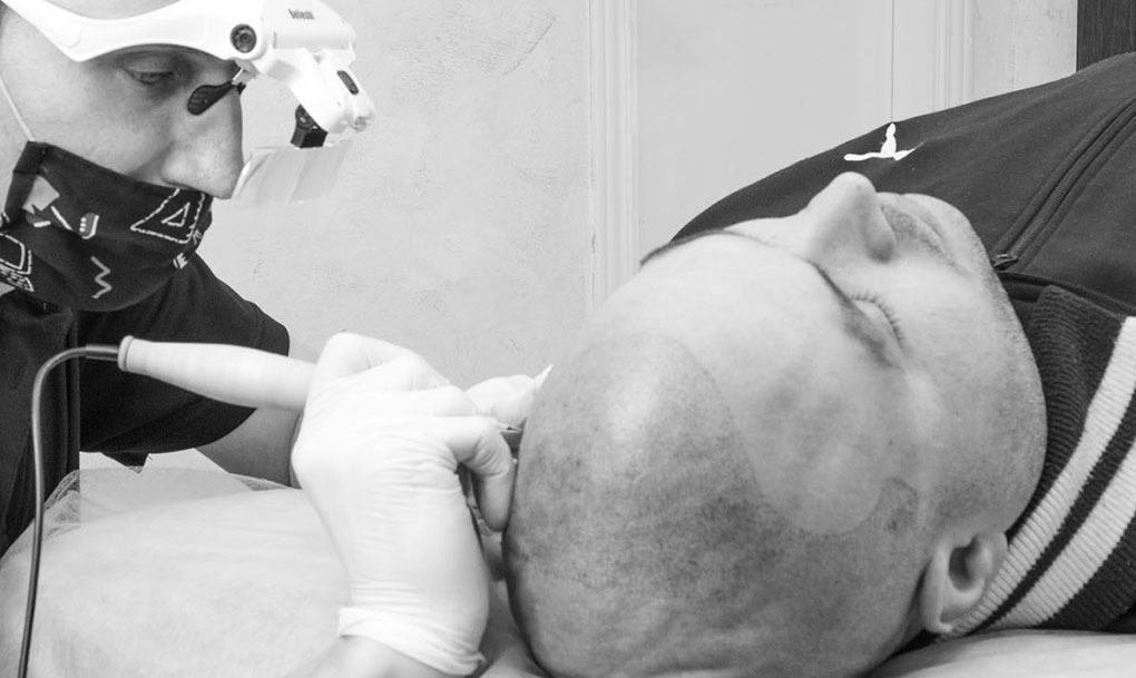 Micropigmentacion capilar