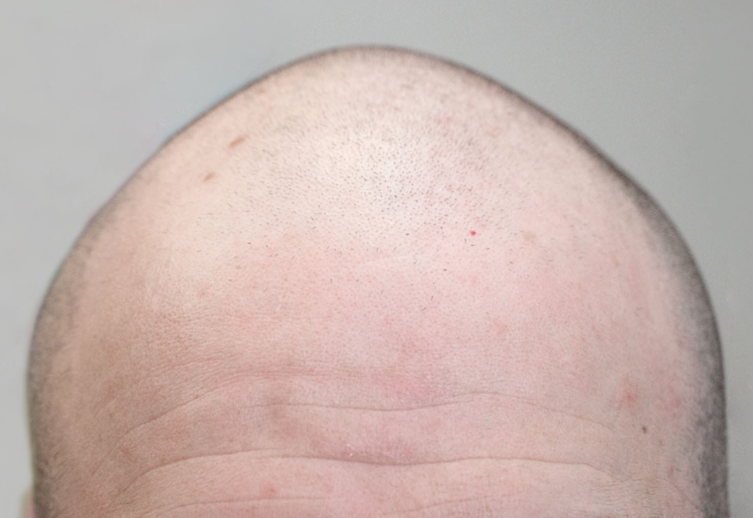 Micropigmenacion capilar antes