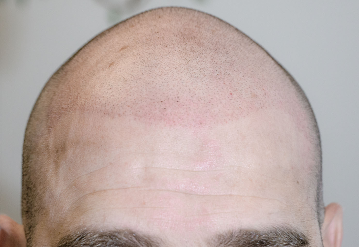 Micropigmenacion capilar primera sesion